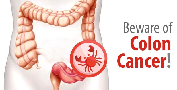 Beware of Colon Cancer | Colon Cancer Symptoms & Treatment