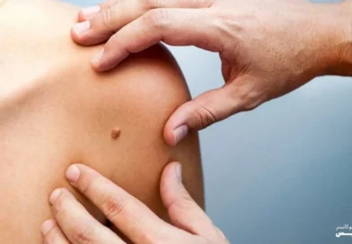 מחקר חדש: מיטות שיזוף מגדילות פי שלושה את הסיכון לסרטן העור