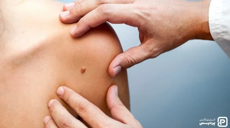 מחקר חדש: מיטות שיזוף מגדילות פי שלושה את הסיכון לסרטן העור